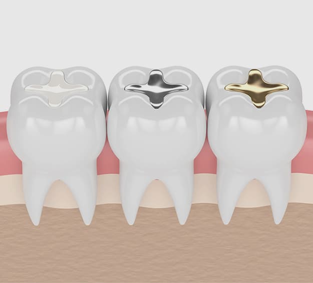 dental filling in san antonio