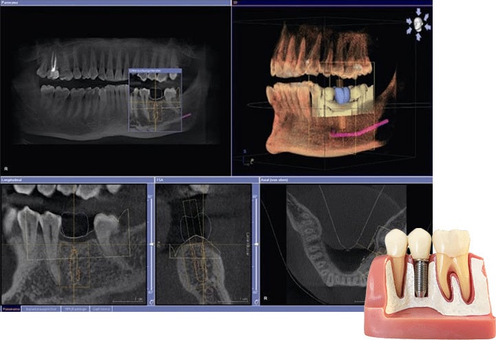 dental implants in san antonio