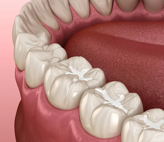 dental sealants in san antonio