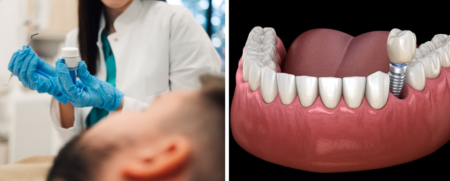 causes greater discomfort: bone graft or dental implant