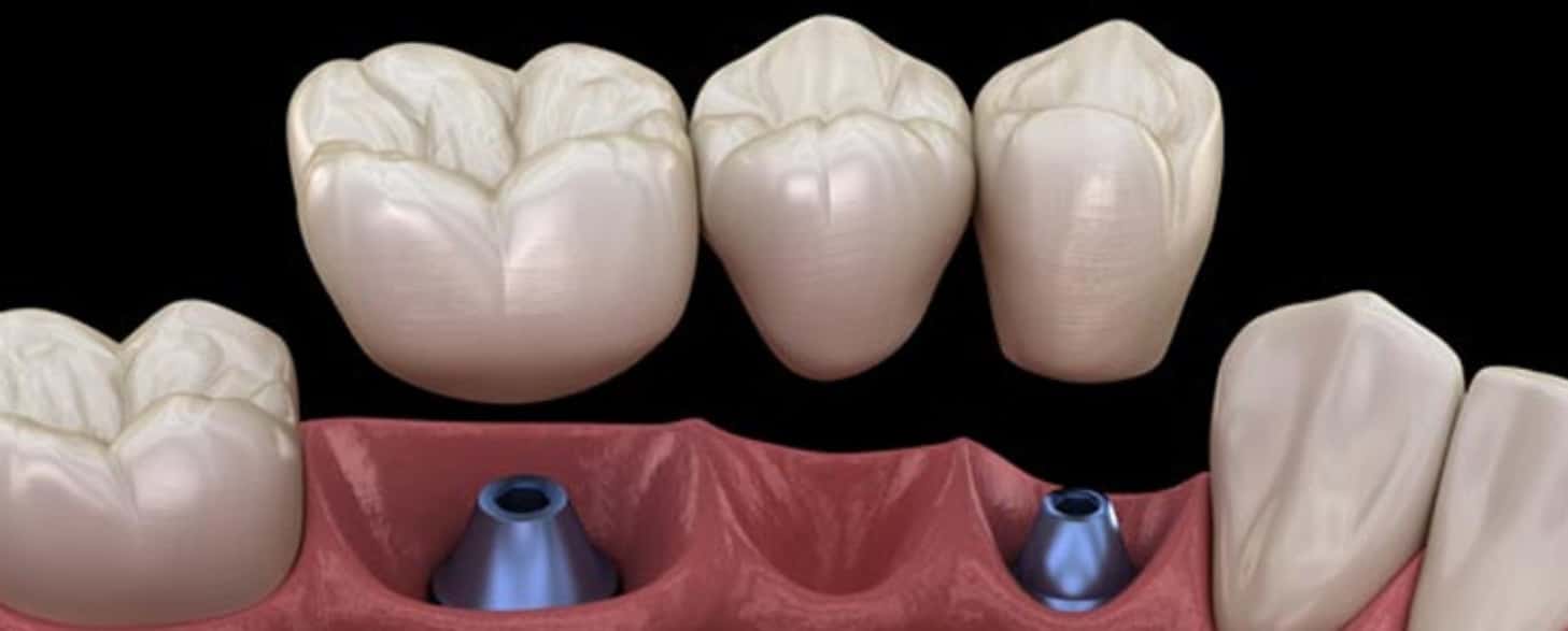 if a dental bridge falls out