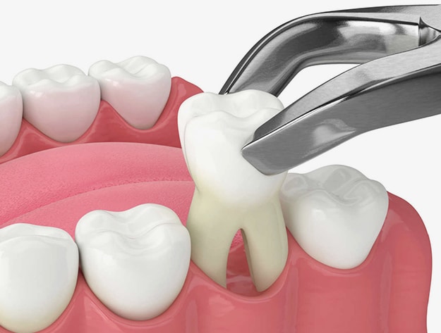 wisdom teeth extraction in san antonio 