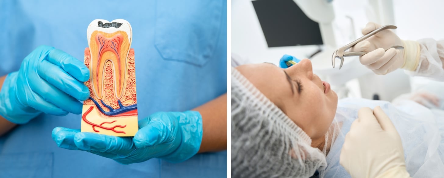what hurts more a root canal or tooth extraction