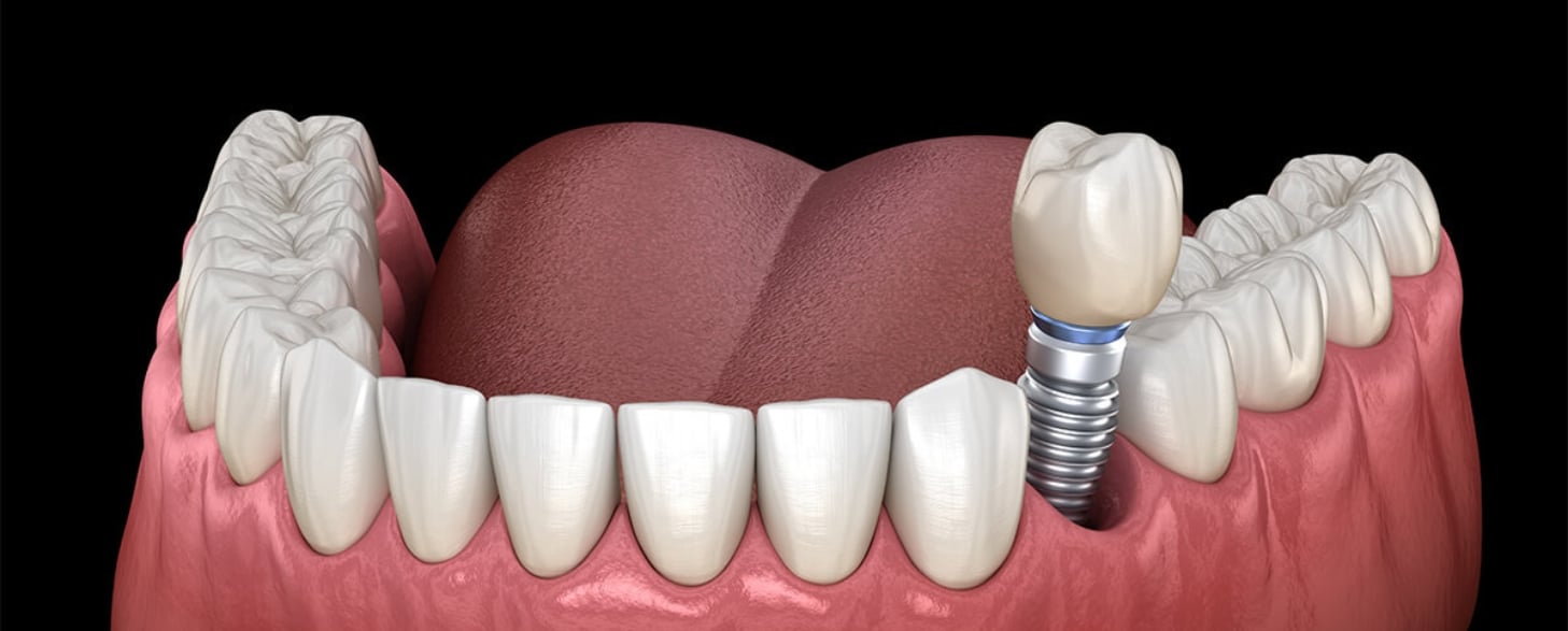 care for your dental implants for longevity: a comprehensive guide