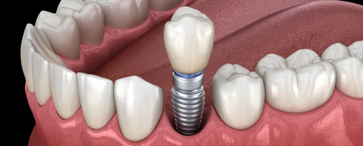 can anyone get dental implants exploring candidacy requirements for san antonio residents