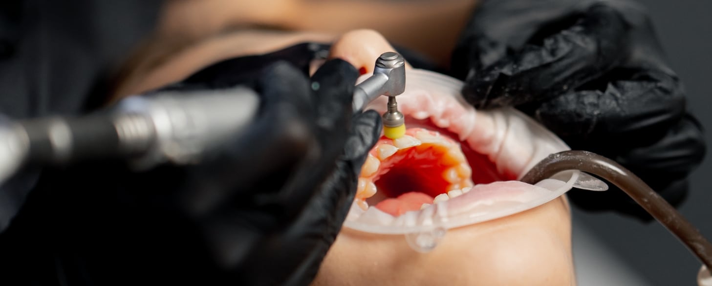 know the limitations of regular dental cleanings