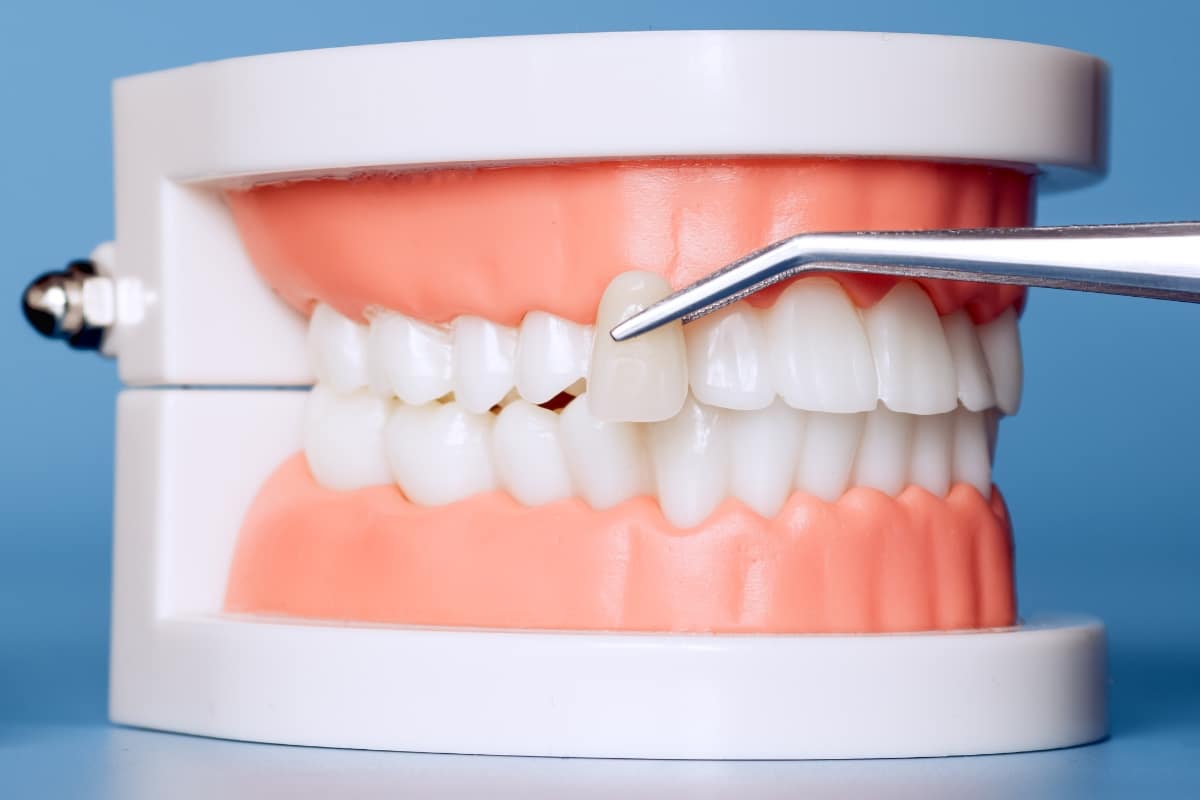 dental-veneers-in-San-Antonio