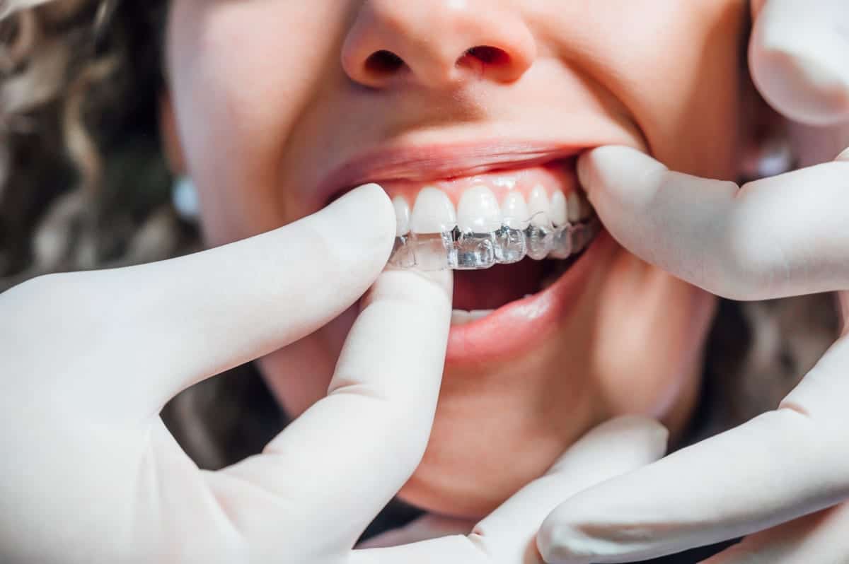 Invisalign in San Antonio