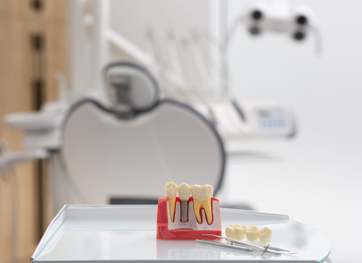 Dental Implants in Helotes