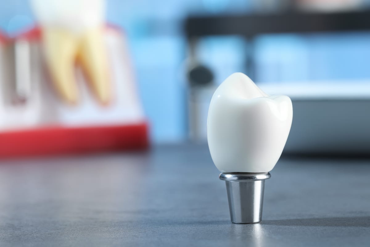 Dental Bridges in San Antonio